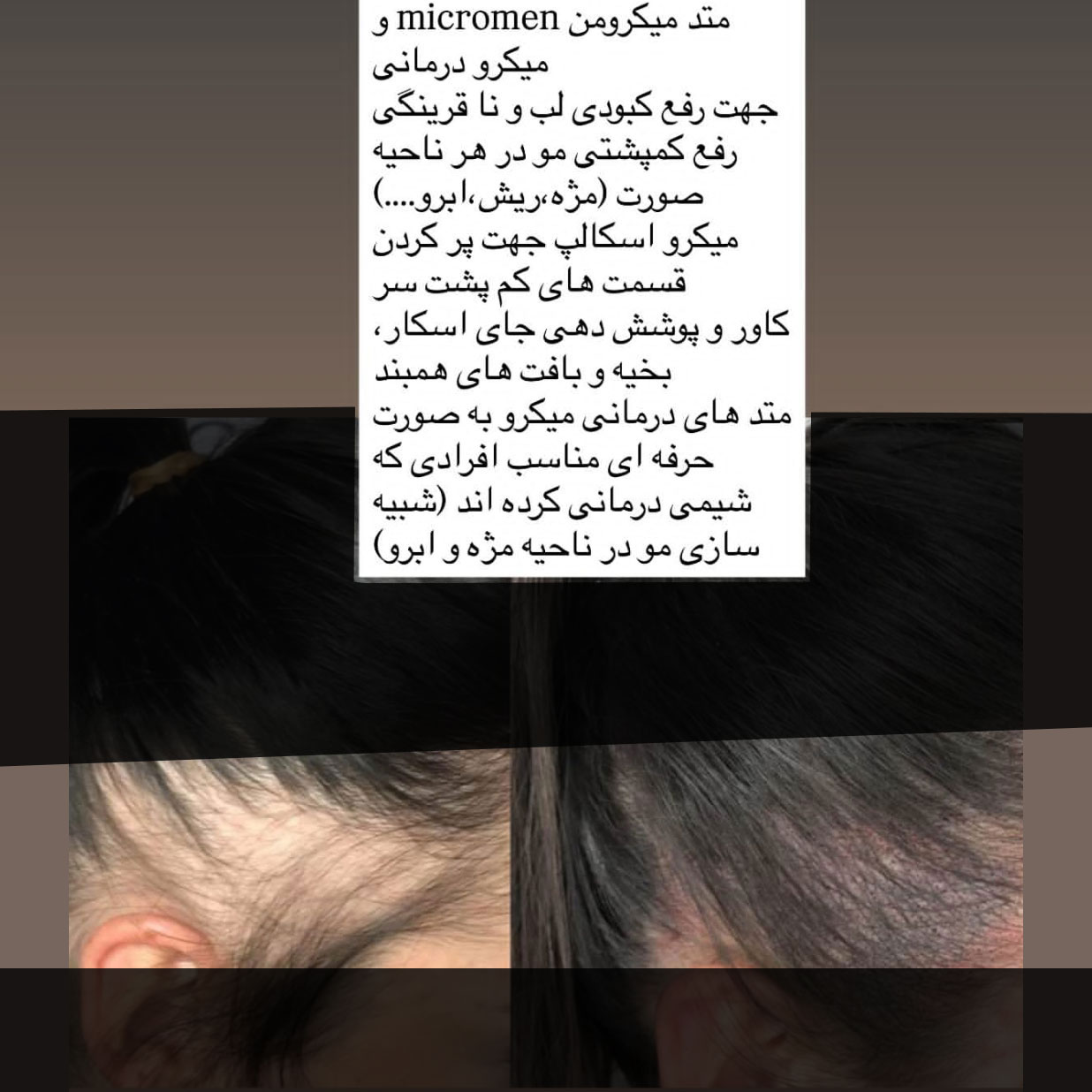 میکروبلیدینگ شقیقه دخترانه
