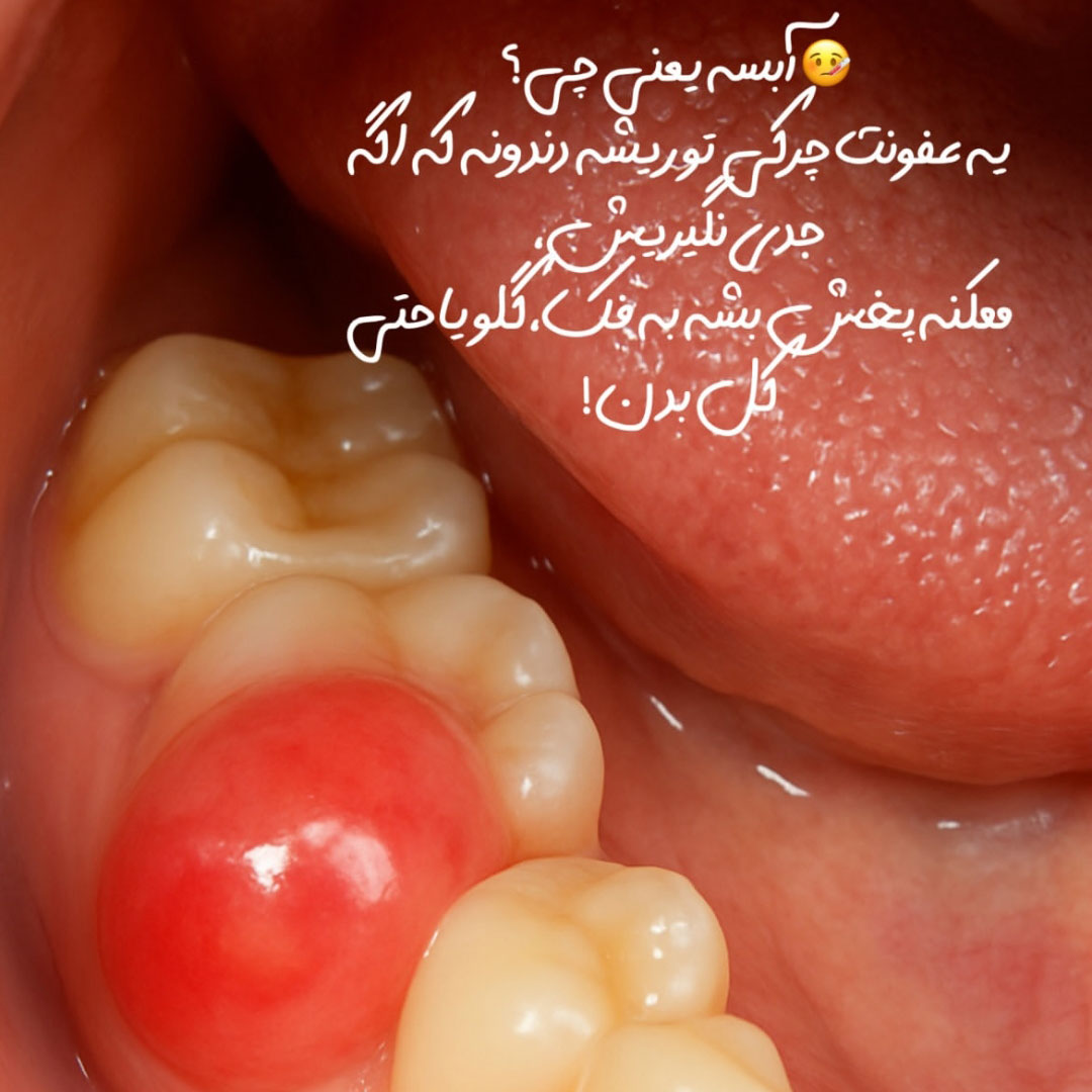نحوه تخلیه آبسه دندان در خانه + آنتی بیوتیک برای آبسه دندان