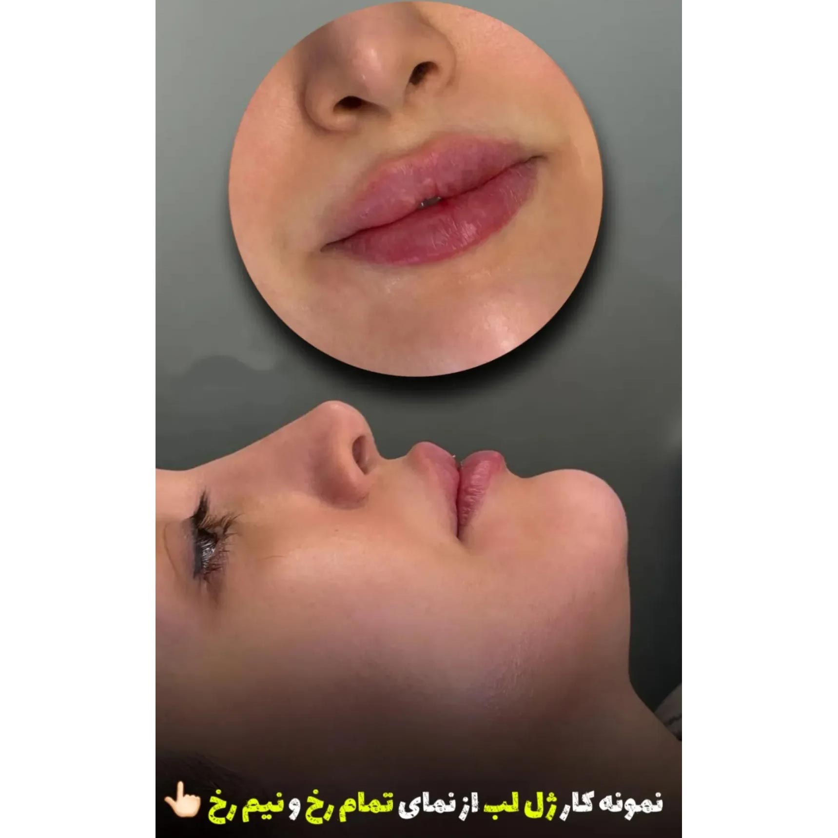 نمونه کار ژل لب از نمای تمام رخ و نیم رخ