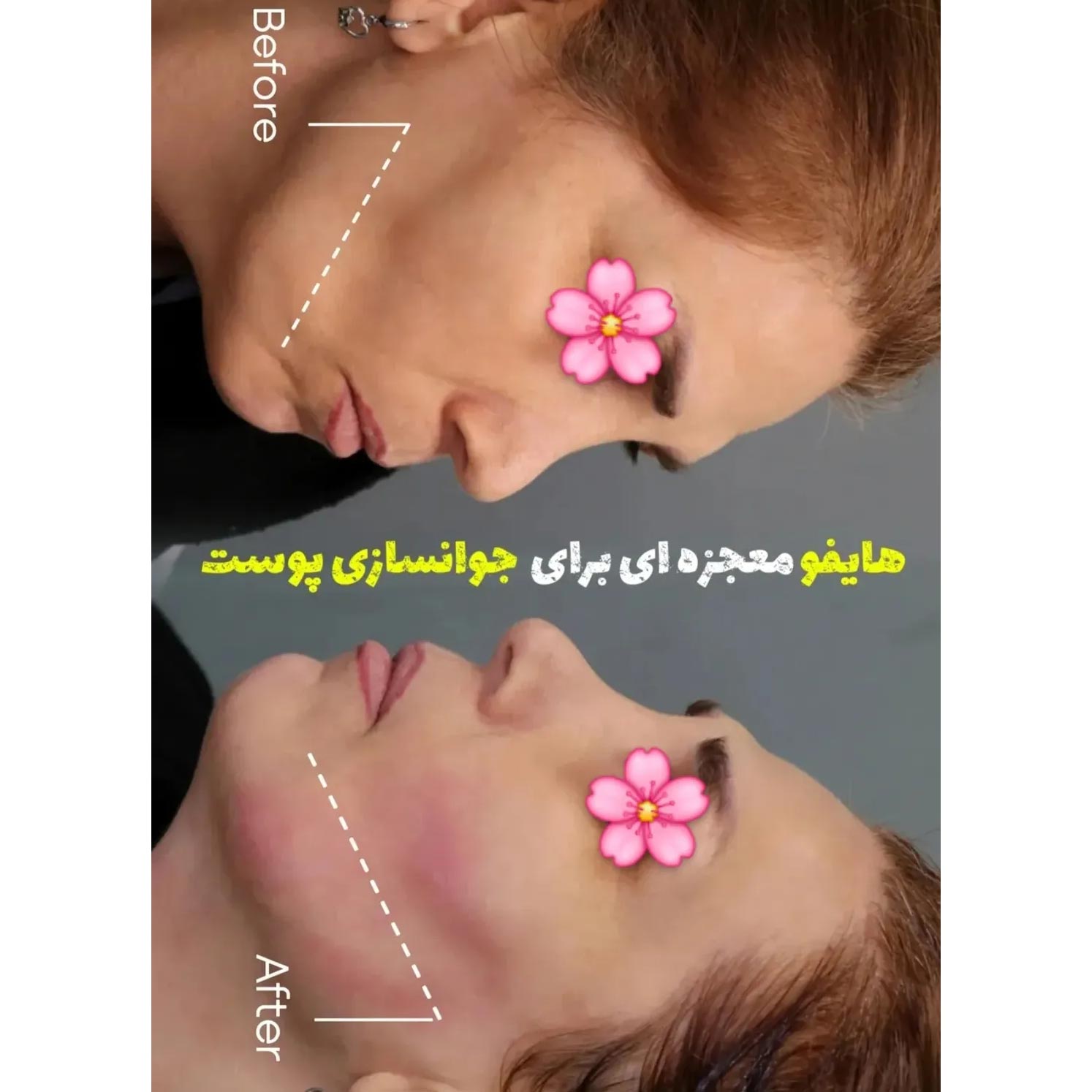 هایفو معجزه ای برای جوانسازی پوست + عکس قبل و بعد