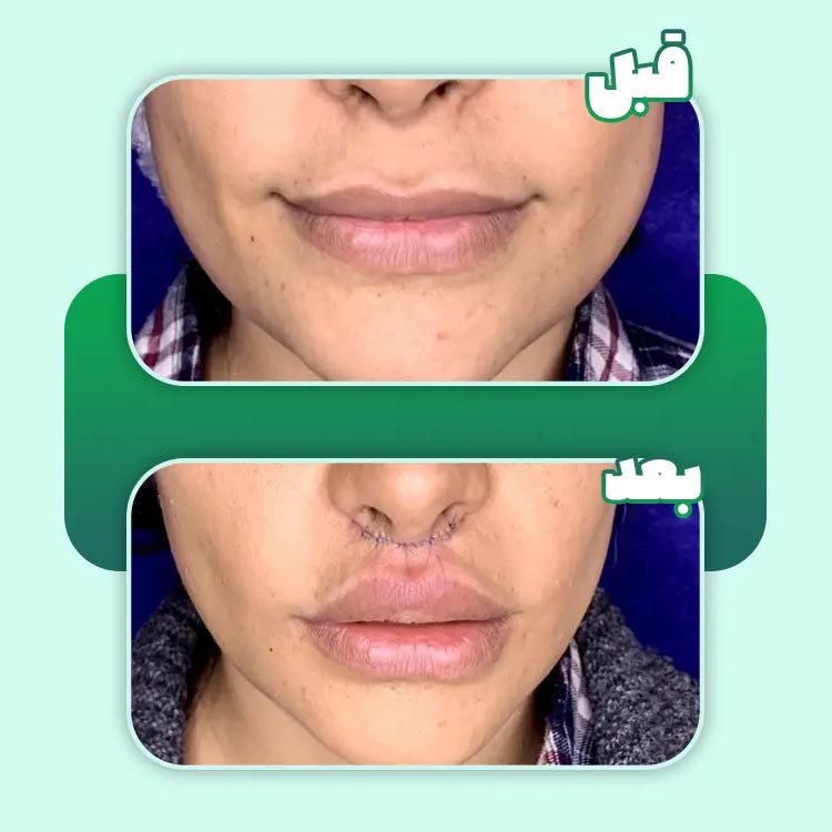 هزینه سانترال لب + عمل سانترال لب