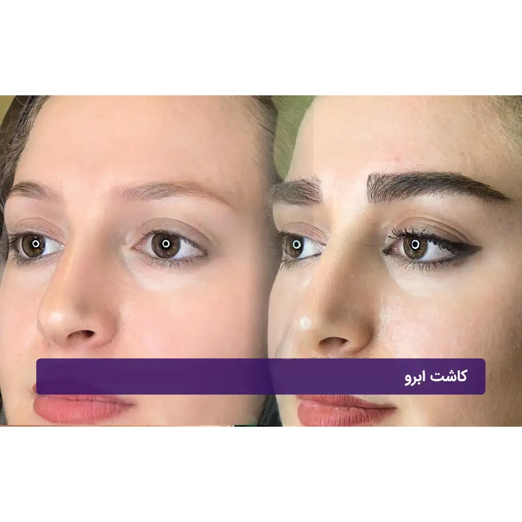هزینه کاشت ابرو طبیعی + عوارض