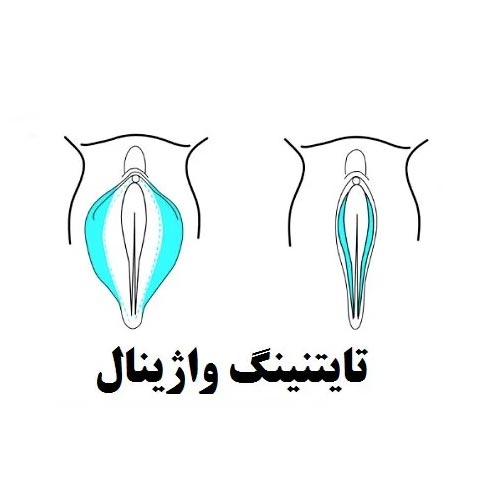 وایتنینگ و تایتنینگ چیست + چقدر ماندگاری دارد ؟