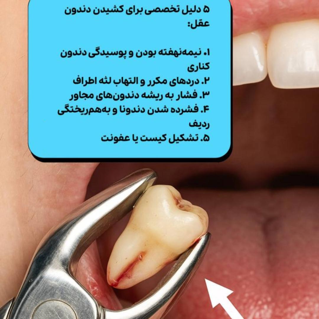 پنج دلیل تخصصی برای کشیدن دندون عقل