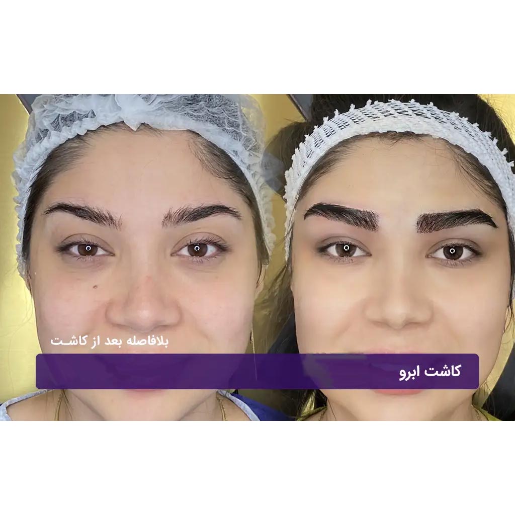 کاشت ابرو طبیعی مردانه و زنانه