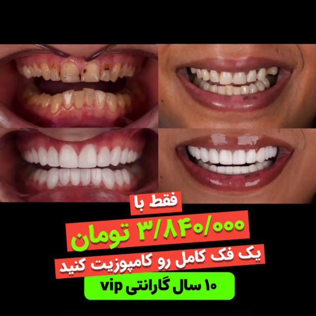 کامپوزیت دندان ارزان