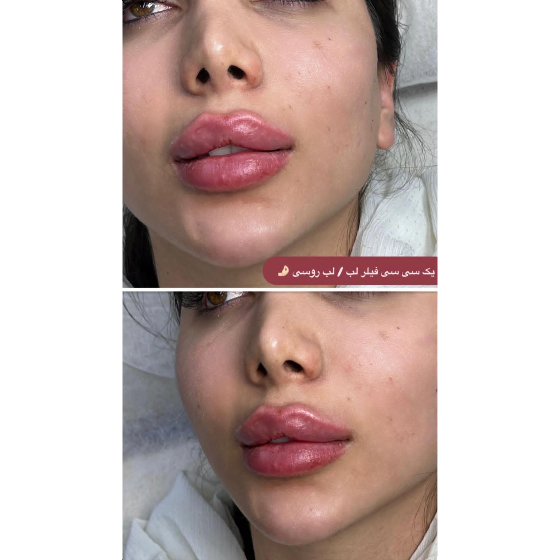 یک سی سی فیلر لب مدل لب روسی