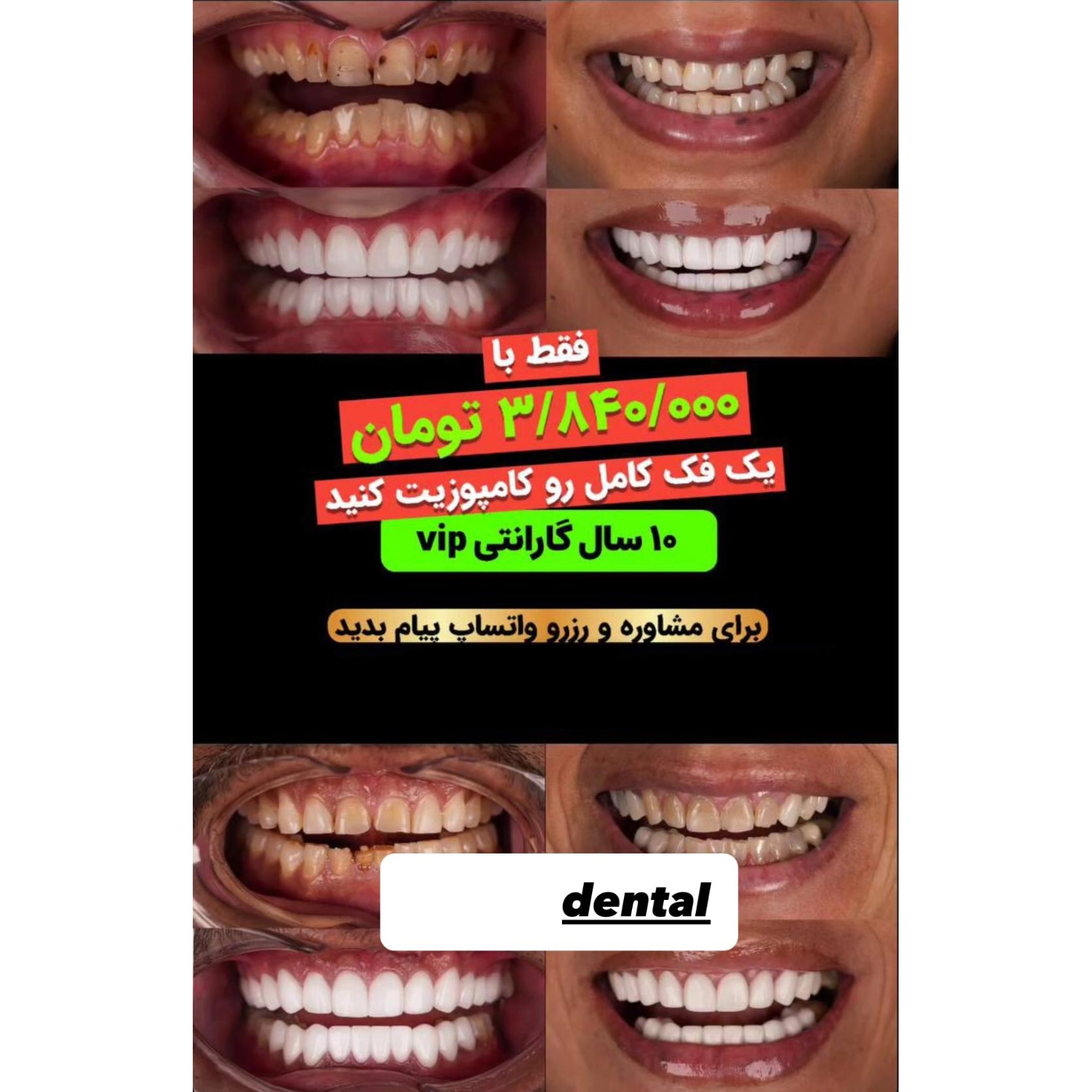 یک فک کامل رو کامپوزیت کنید فقط با قیمت 3میلیون تومان